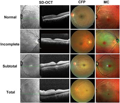 Clinical application of multicolor scanning laser ophthalmology in diagnosis and grading of central retinal artery occlusion